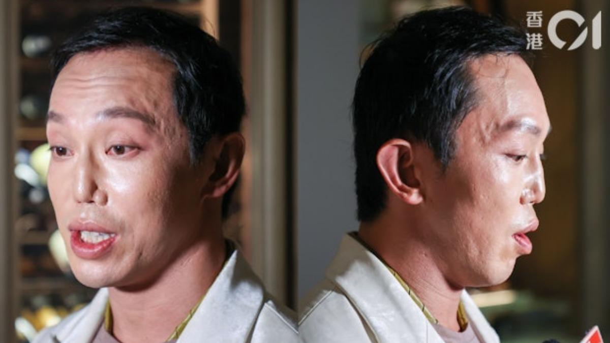 陳柏熹車禍毀容重建後首露面。（圖／香港01）