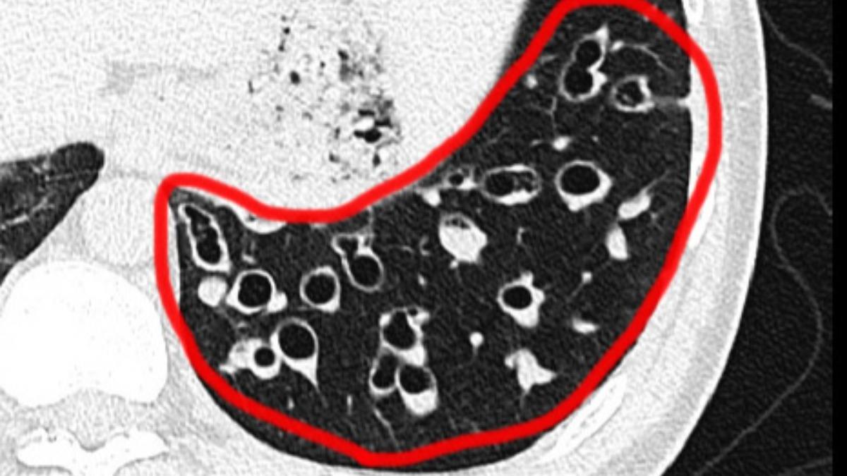 台中一名甘姓男子罹患支氣管擴張症，可見肺部氣管旁有黏液堆積（白色處），痰液大量堆積。（圖／台中榮總提供）