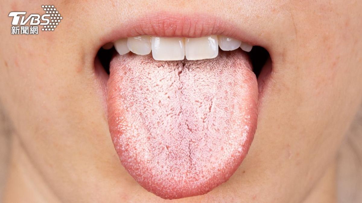 透過舌苔的顏色可初步識別身體的潛在健康警訊。（示意圖／shutterstock達志影像）