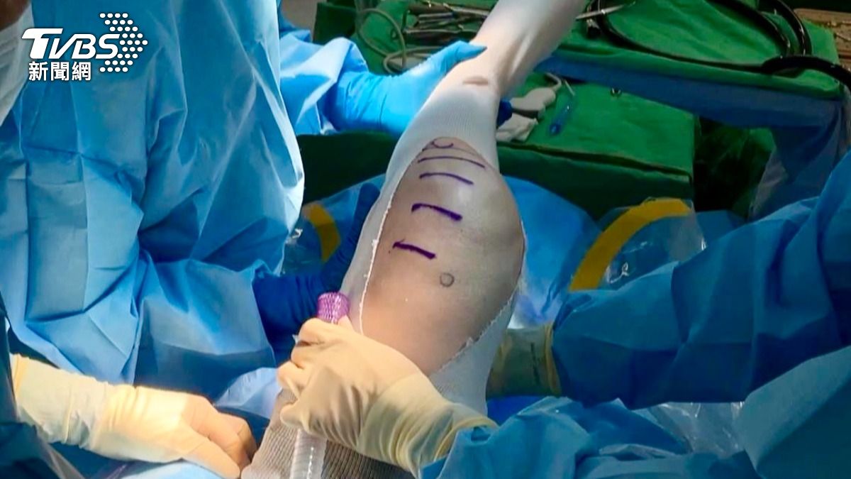 膝蓋退化!醫師:早期診斷 能有效延緩老化 (圖/TVBS)