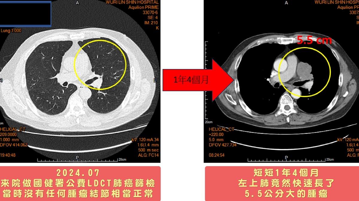 台中一名黃姓老菸槍，原本檢查相當正常，結果隔年卻罹患小細胞肺癌末期。（圖／烏日林新醫院提供）