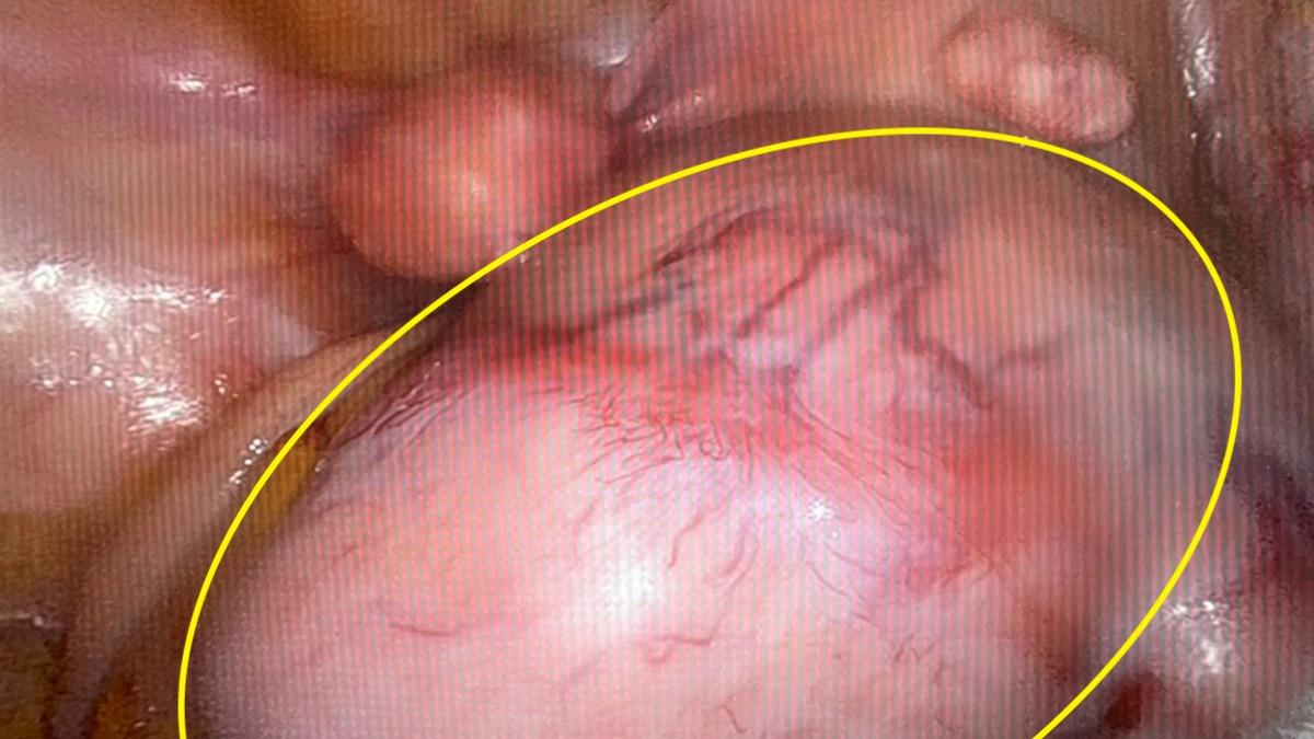 台中一名35歲女子子宮長出「9顆子宮肌瘤」，緊急動刀切除。（圖／澄清醫院中港院區提供）