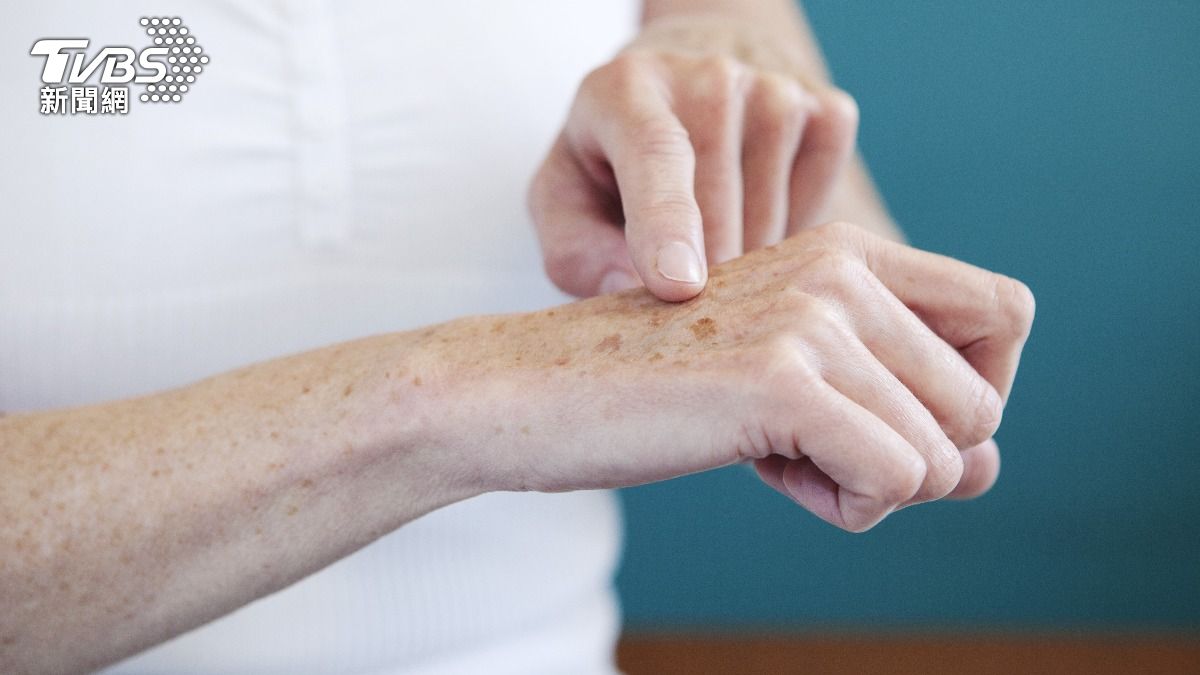 美國醫師甘德里指出，老人斑其實是全身正在老化的警訊。（示意圖／shutterstock達志影像）