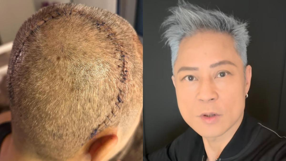 蔡一傑罹腦瘤開刀…休養1年復出！　彩排吐感動：再次踏上草蜢舞台