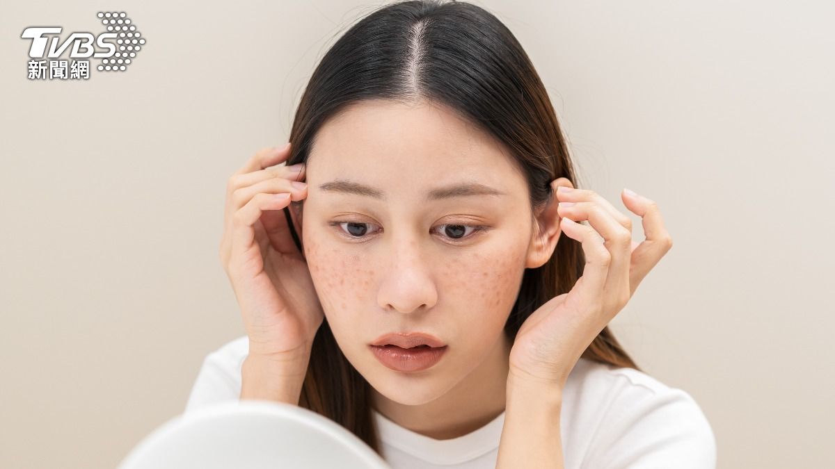 台灣3成女性長肝斑「紫外線、壓力」都影響 雷射效果有限