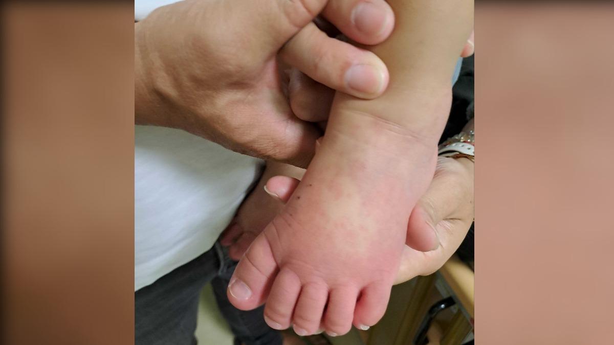 連日發燒狂哭!台中童手腳「腫得像麵龜」 醫急喊:恐猝死