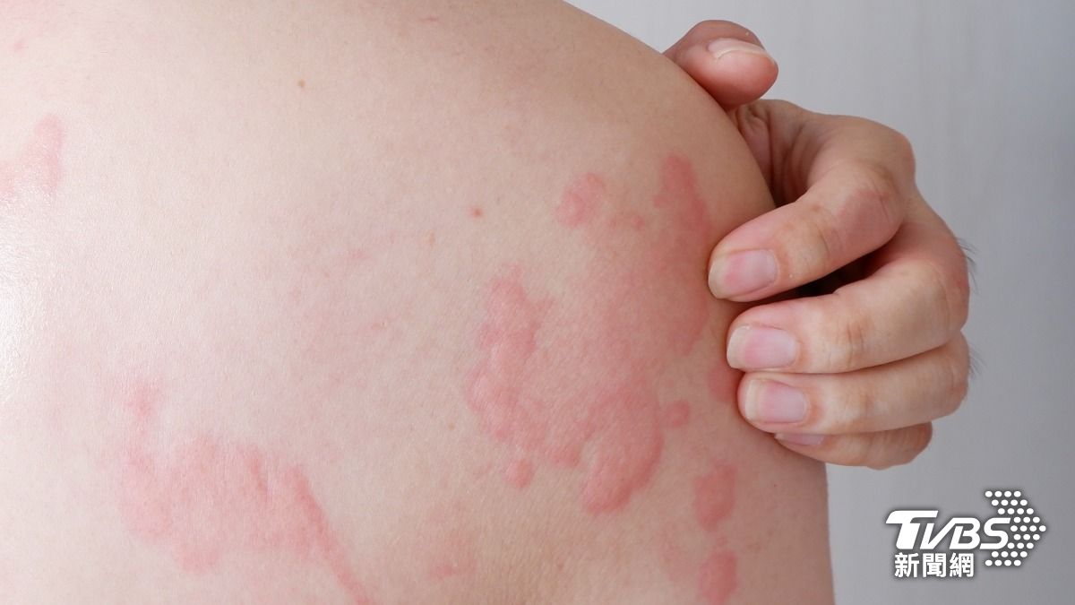 大家總對我過敏!日科學家曝罕見怪病:患者釋放甲苯濃度多40倍