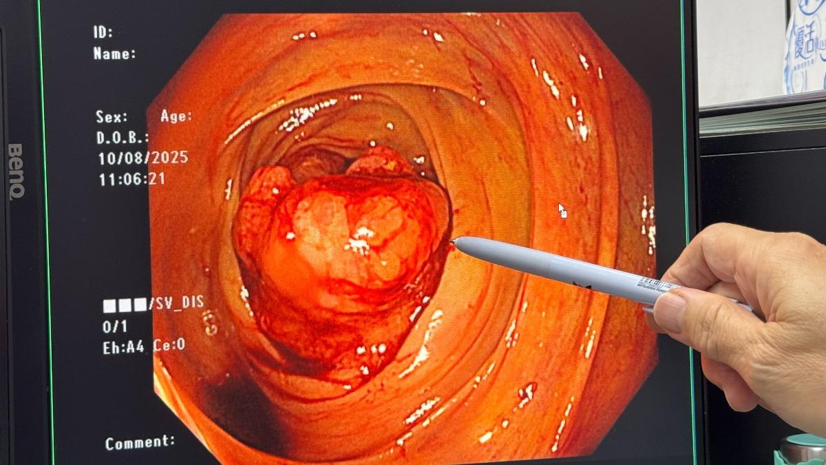 愛吃2食物!台中婦罹大腸癌蹲整天馬桶 醫嘆:7徵兆危險了