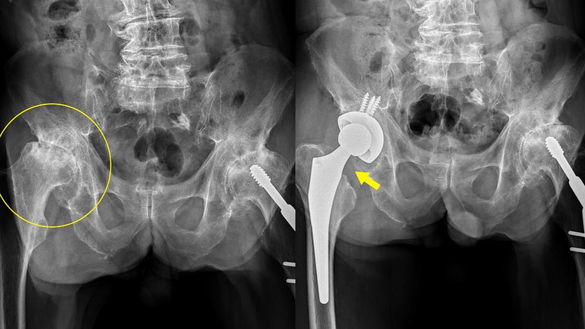 忍痛抱病替母翻身…台中孝子伴到盡頭　拖到髖骨磨光站不了