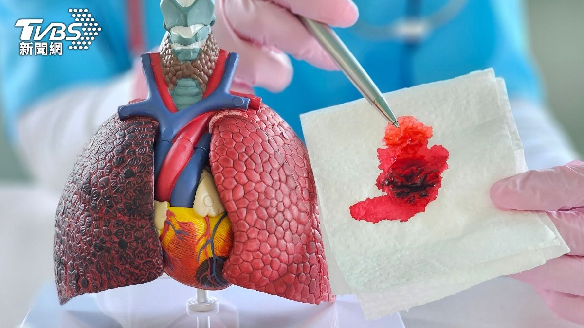 不吸菸也中招!發現肺腺癌恐「已晚期」 醫籲6大警訊:及早篩檢