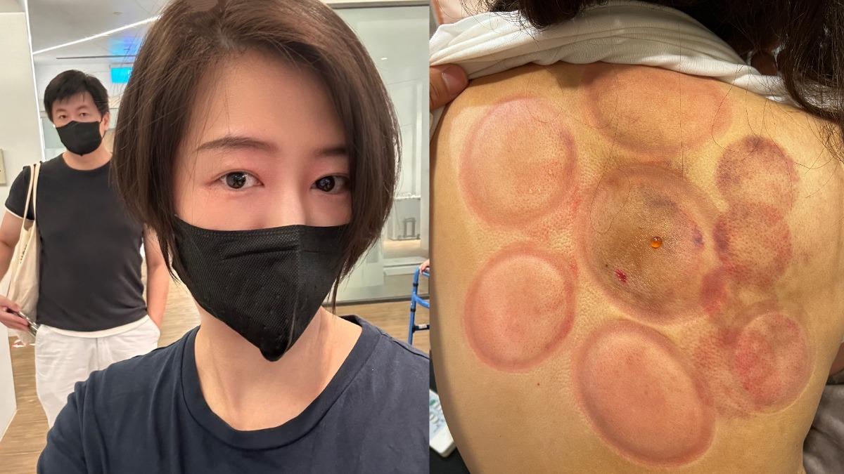 八點檔女星急入院動刀!曬術後照「最美麗的記號」 尪心疼發聲