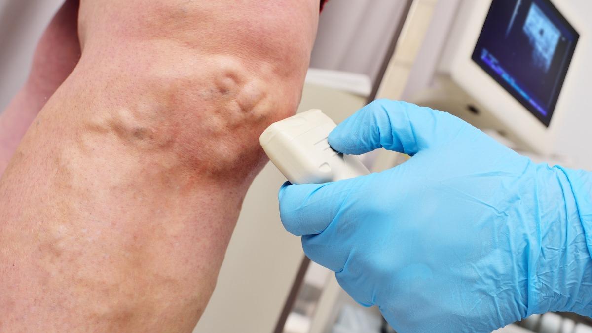 再拖恐截肢!台中師腳冒「恐怖石塊、蚯蚓」 4類人4症狀小心