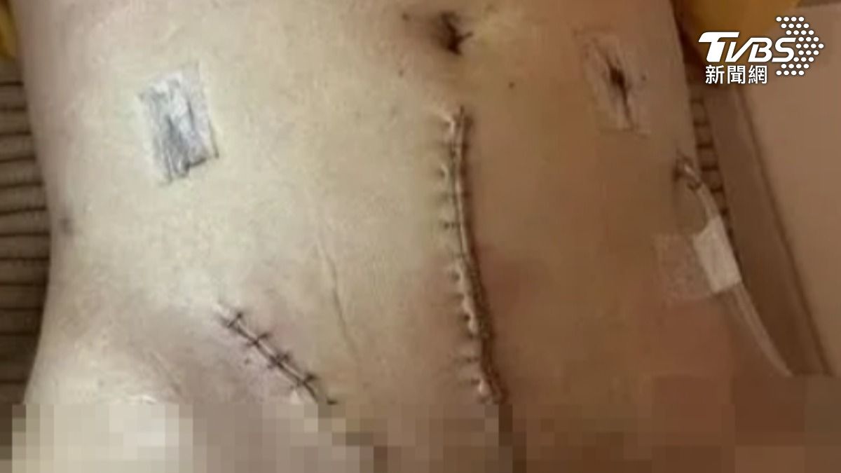 微創手術險沒命！　肚皮留長疤　女崩潰控醫療疏失