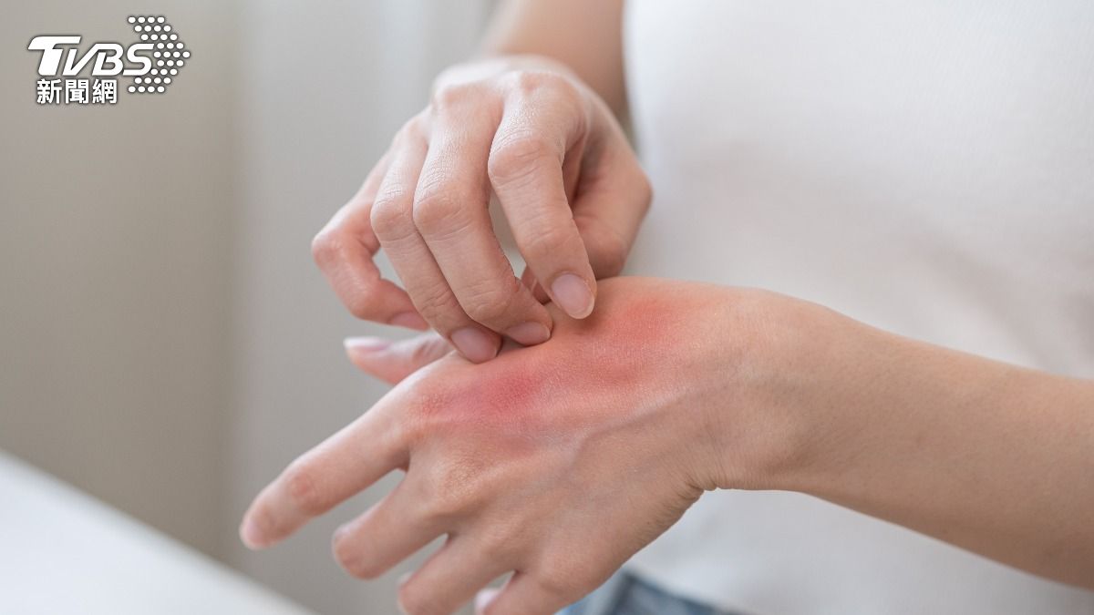 癢到睡不著？研究揭「薄荷醇」能抑制癢感　中醫大：全身都有效