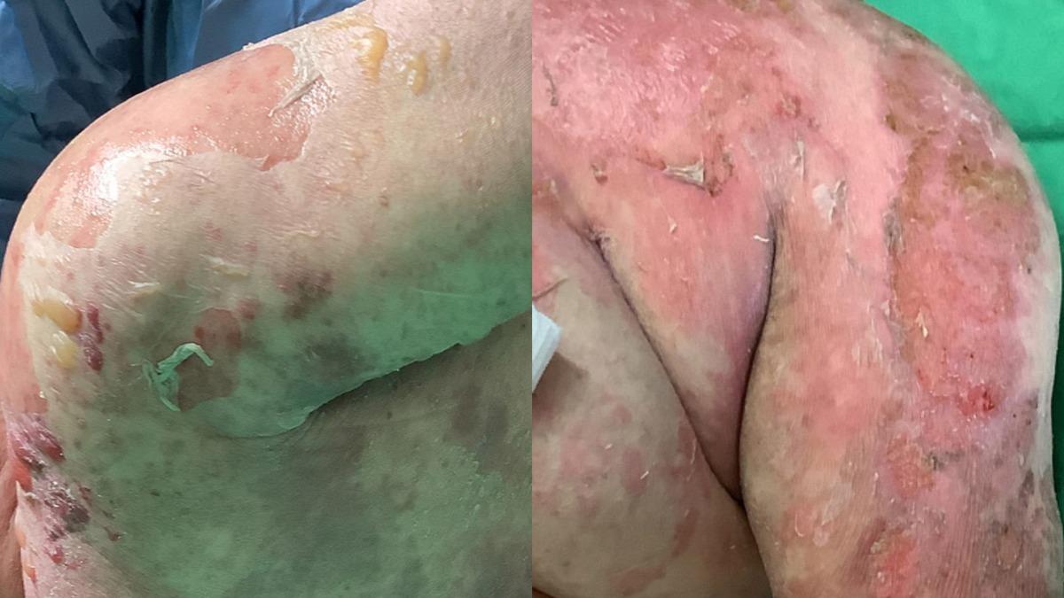 吃1藥引爆罕病!台中女全身爛長紅疹 皮一摸就破死亡率3成