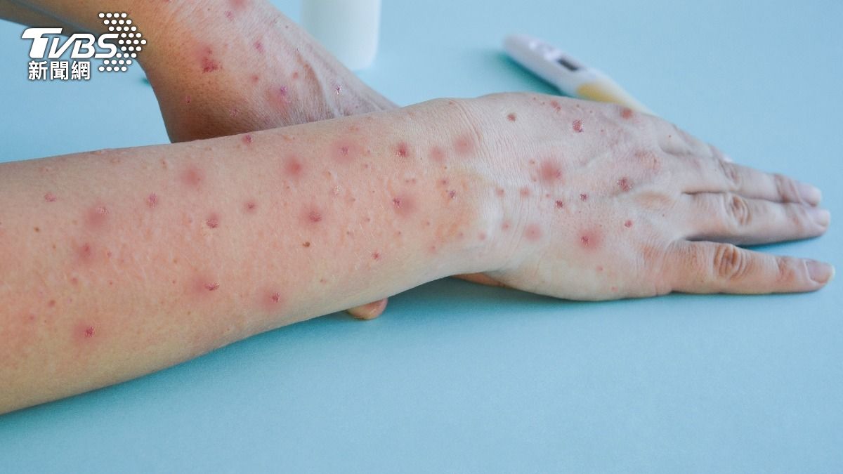 衣索比亞爆發「馬堡病毒」!至少9人確診 尚無疫苗可治