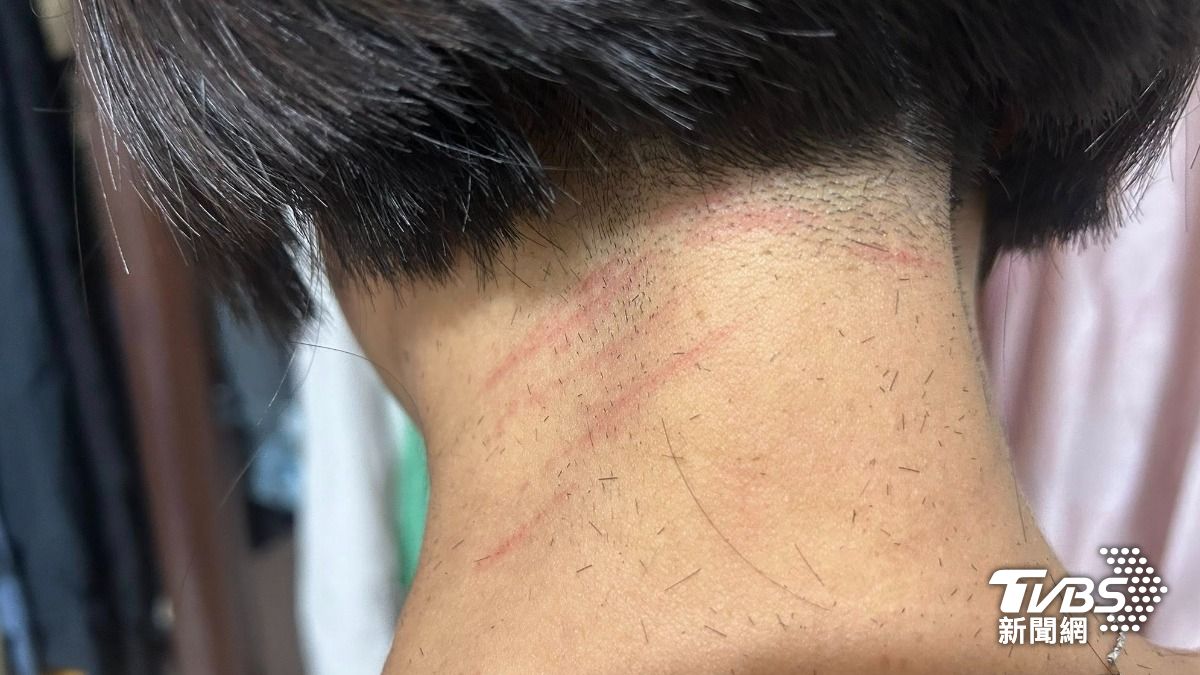 10分鐘快剪釀慘案? 女後頸「8道紅痕」嚇壞老公