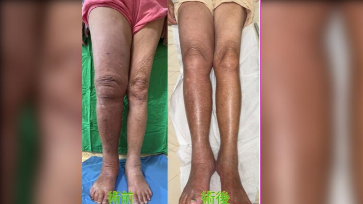 罹癌動刀引水腫！台中嬤斷腿卻無法復健　脫褲見右比左腳腫三倍