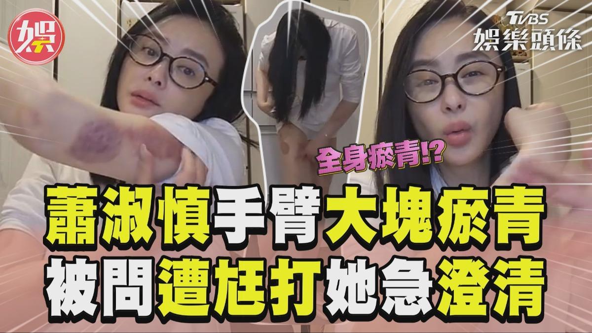 影音/蕭淑慎直播秀手臂「大塊瘀青」 被問遭尪打她喊:他敢早就住院