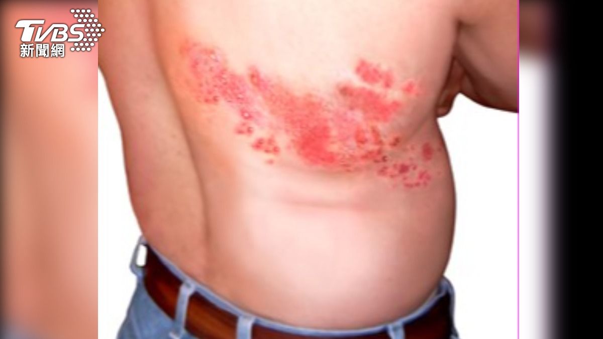背痛像火燒竟是帶狀皰疹 醫:「紅疹+水泡」沿肋骨排列