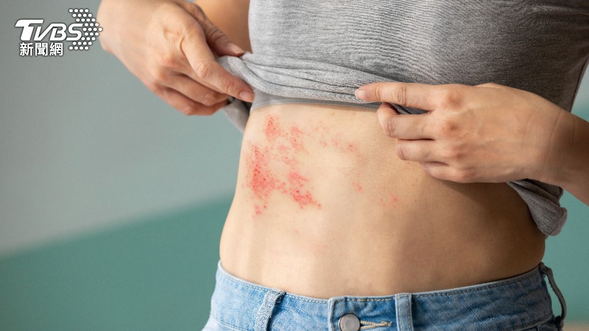 皮蛇別輕忽！醫示警「3部位」立即就醫：這些人更容易中標