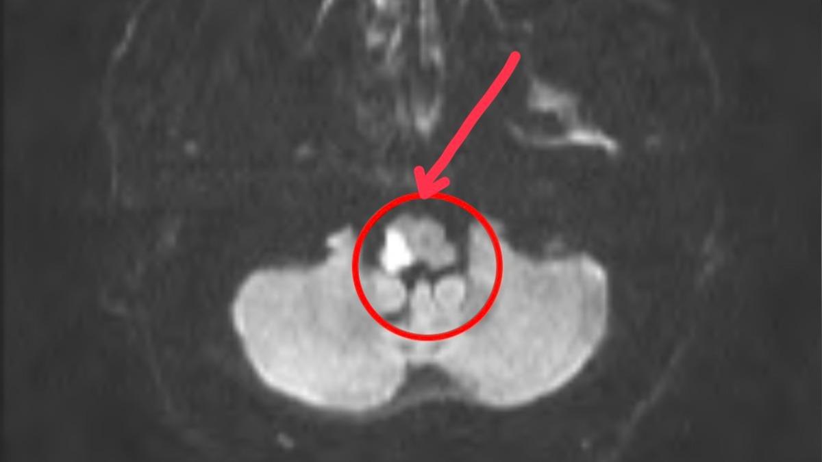 天冷現2非典型症狀！男以為沒事「已腦幹中風」　再拖恐猝死