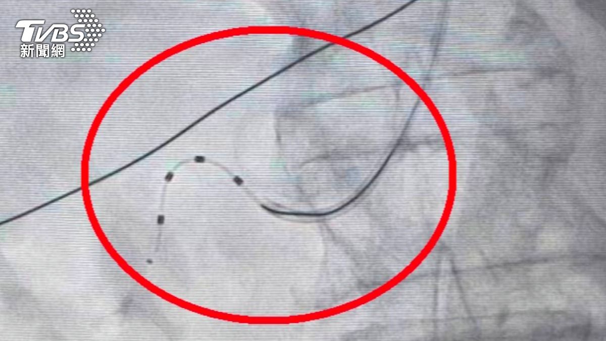 吃7種藥也沒用？85歲嬤頻失控　醫揭「難治型高血壓」