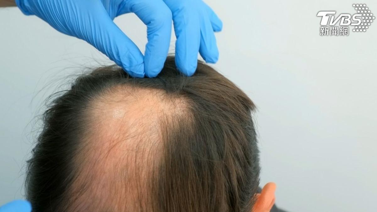 洋蔥汁助生髮？醫曝禿頭元凶　「做好1事」髮量就回來　