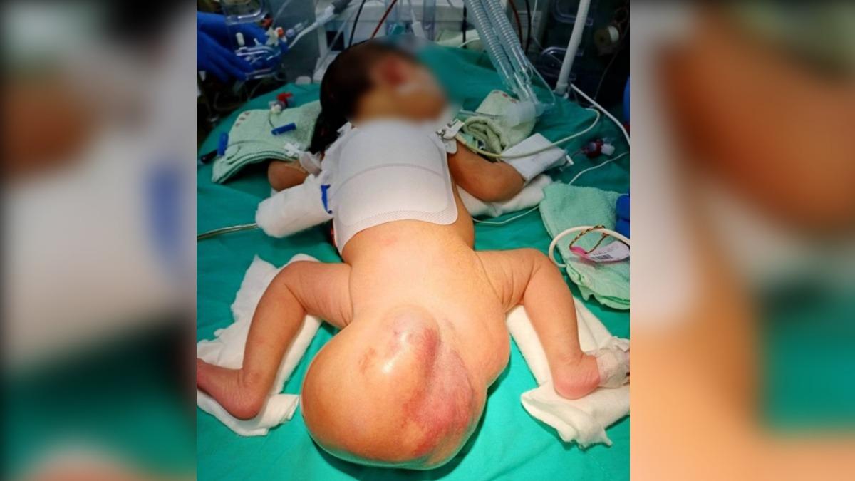 成因不明！台中女嬰患罕見畸胎瘤　出生「臀掛16公分巨球」