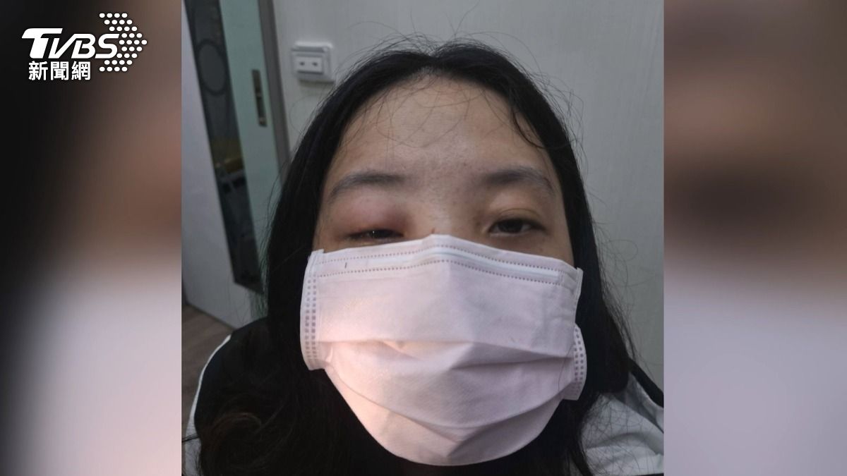 香水太香? 戴全罩式安全帽仍遭蜂螫 正妹視力驟降剩0.7