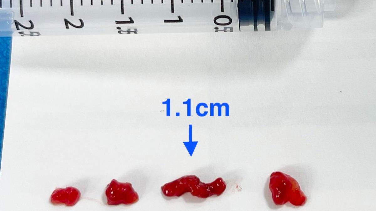 14歲學生上課突倒下!醫速取出4血栓搶命 最大1.1公分