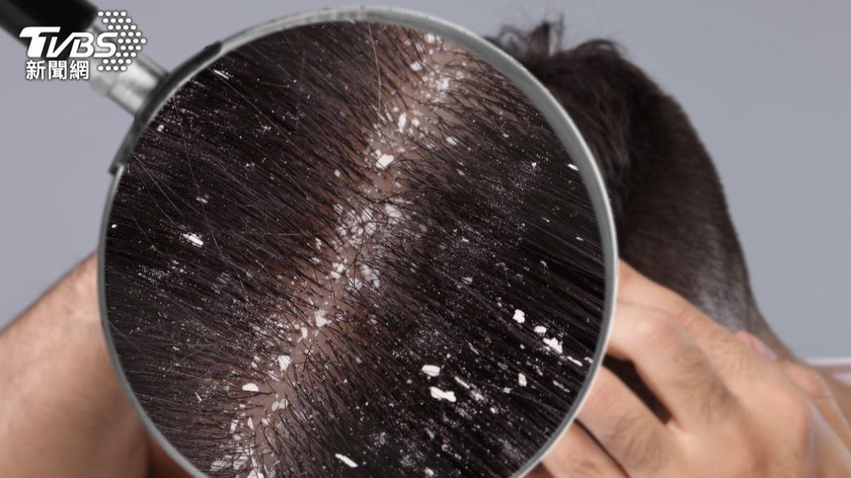 換季頭皮乾癢、頭皮屑狂飄?醫揭頭皮長黴 4招遠離「雪花滿天」
