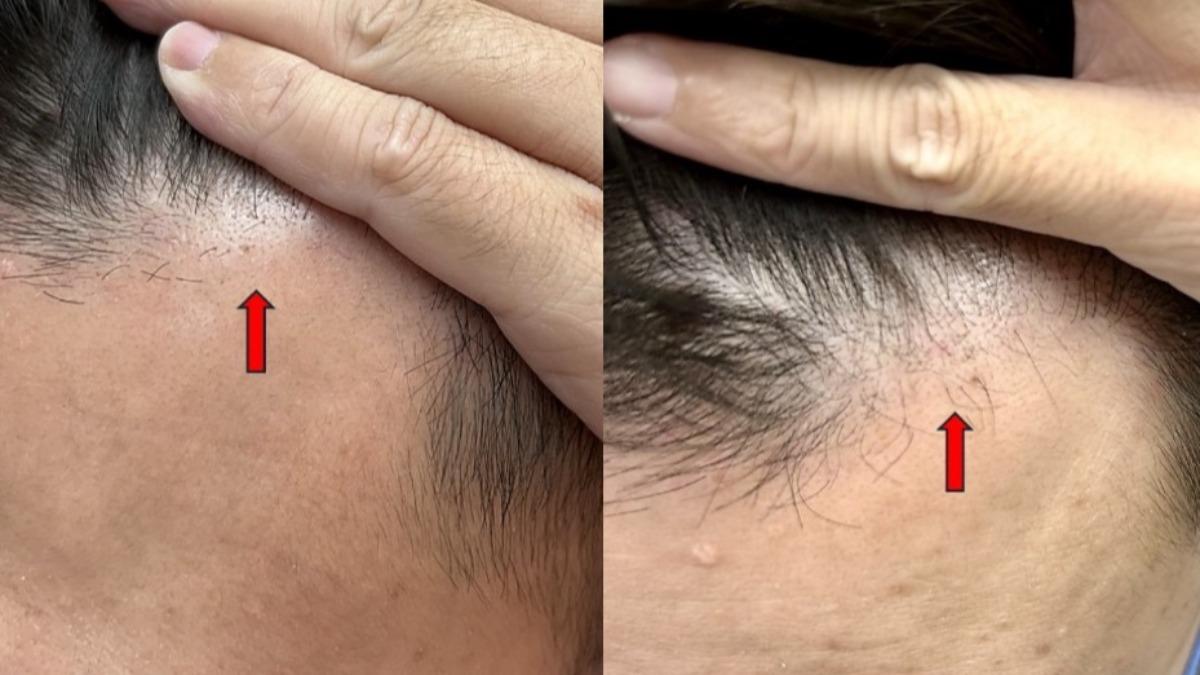 35歲男髮際線後退！中醫美顏針改善M型禿　治療1個月長出新生髮