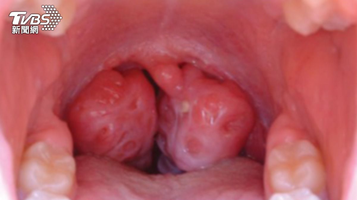 反覆發燒喉嚨痛不停!誤以為感冒 醫警告:拖太久致死風險高!