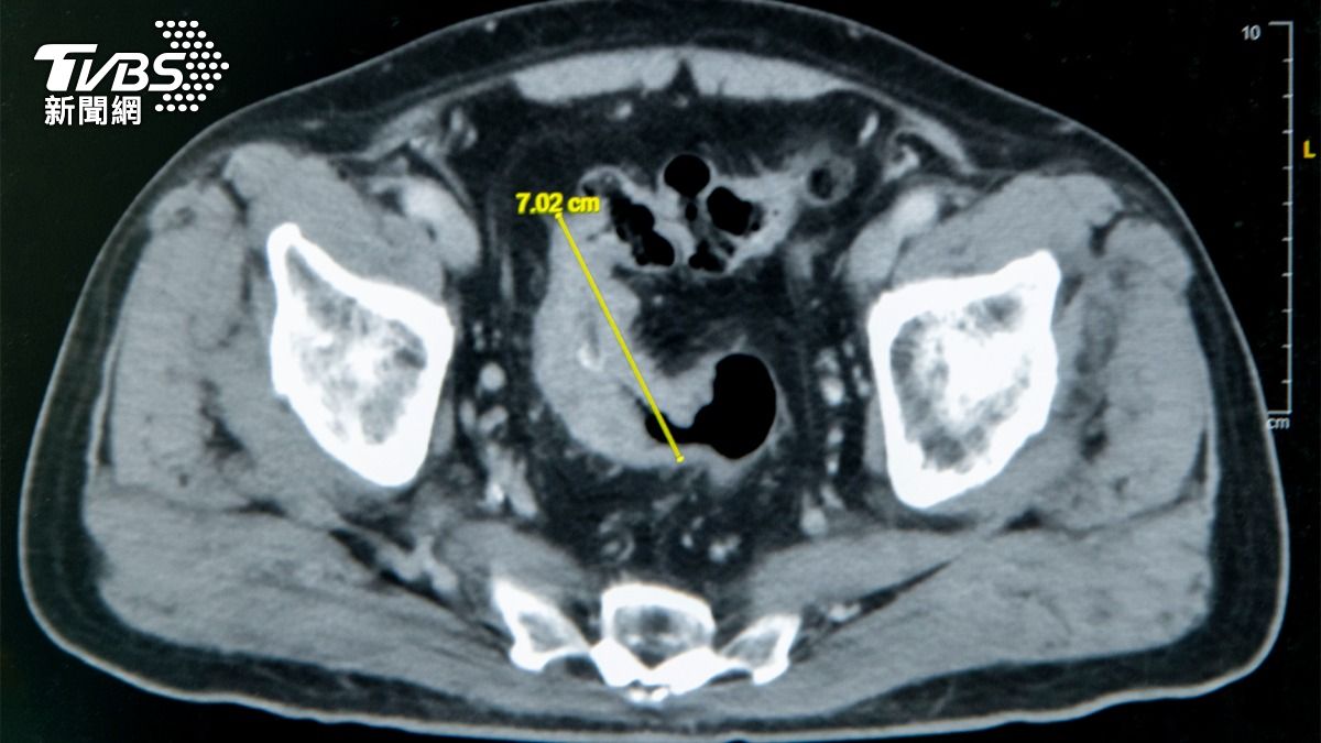 一半時間都在蹲馬桶!翁便祕半年長7cm腫瘤 腸道險全堵死
