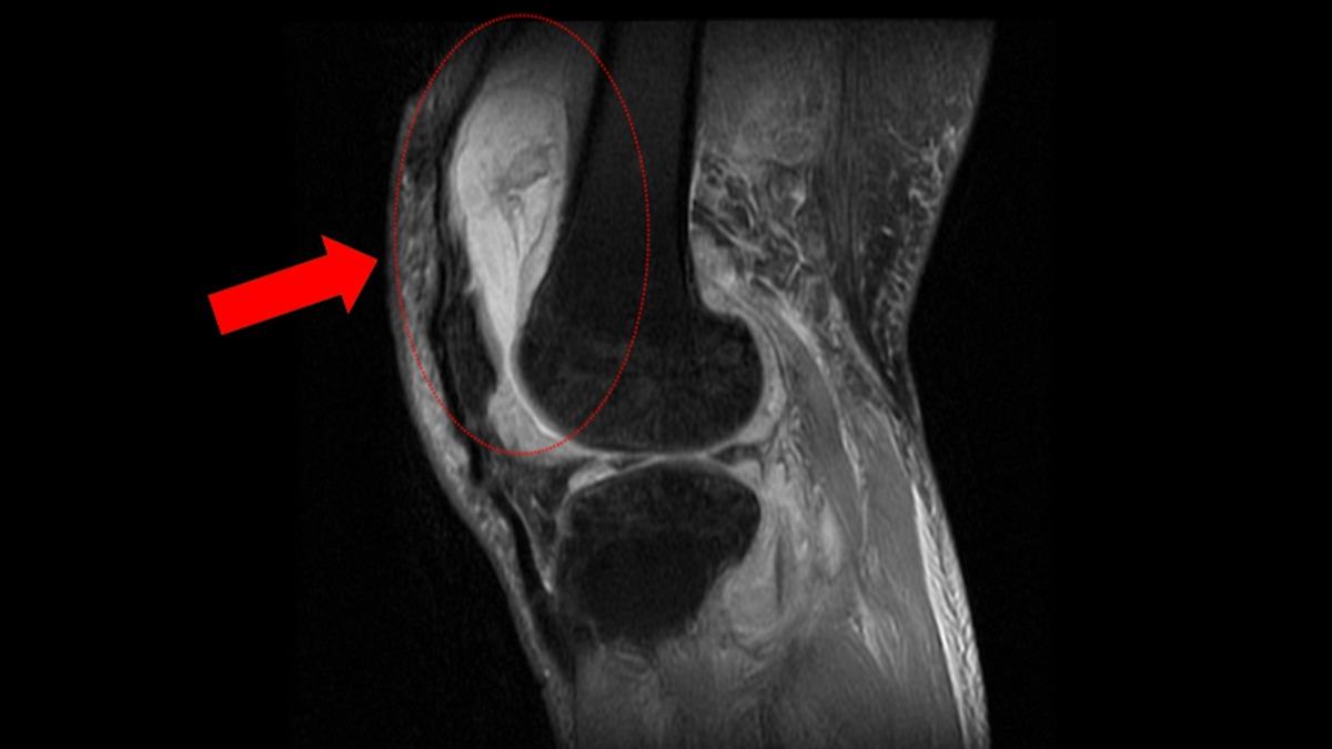 腳腫痛無法彎！台中翁遭細菌「啃骨化膿」走不了　5徵兆注意