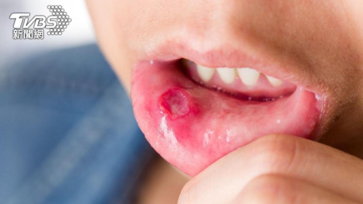 不只是上火！中醫揭「口瘡」背後成因　3大地雷食物別碰