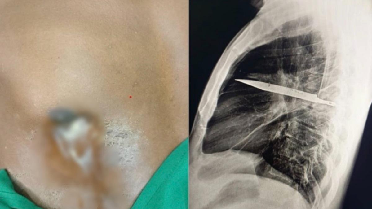 乳頭狂流惡臭膿！X光片一照「1金屬」卡胸8年　醫護全嚇傻