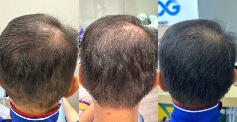 告別頭皮危機！吳依霖搶先體驗愛爾麗「拉髮密雷射」強調：頭皮健康才是秀髮根本！