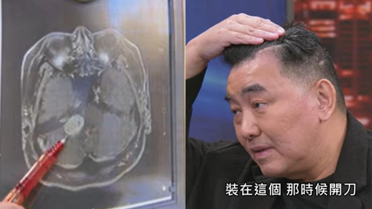 徐亨欠債2億元破產離婚！昏倒送醫「長3公分腦瘤」　靠1儀器維生