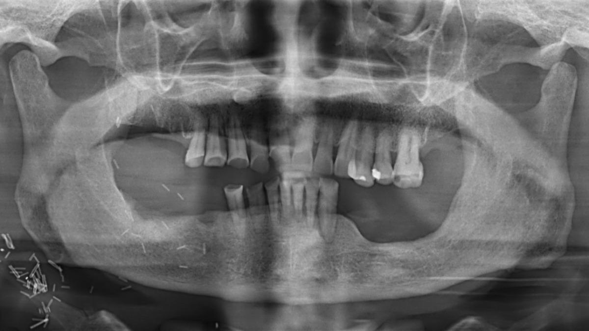 罹口腔癌切顎保命!台中男只能張口2公分 悲嘆:吃飯成奢望