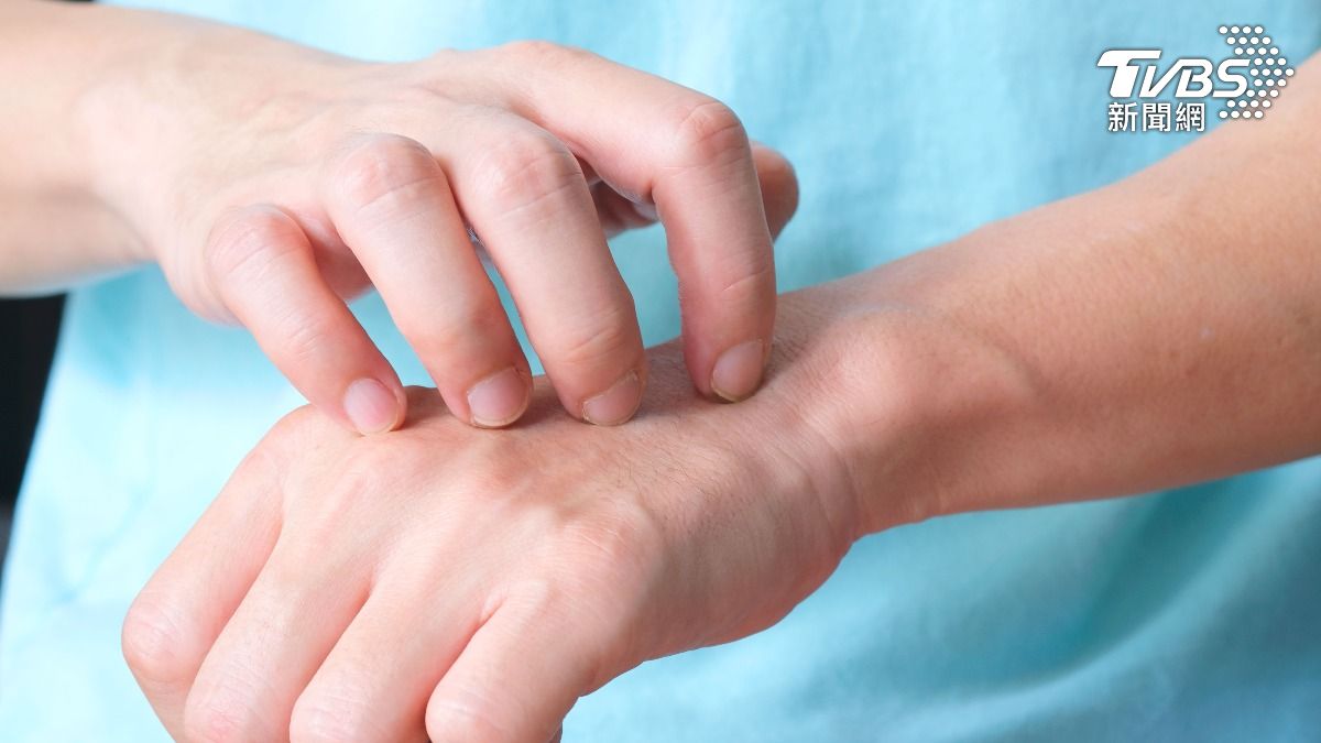 露營回家手突冒紅斑！年輕男擦藥沒效　就醫驚知「梅毒二期」