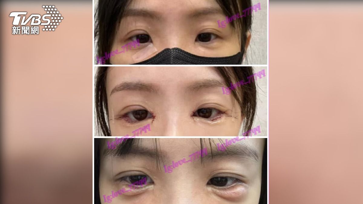 網紅推上海醫美釀禍？女花12萬術後「眼下腫脹」求救台醫