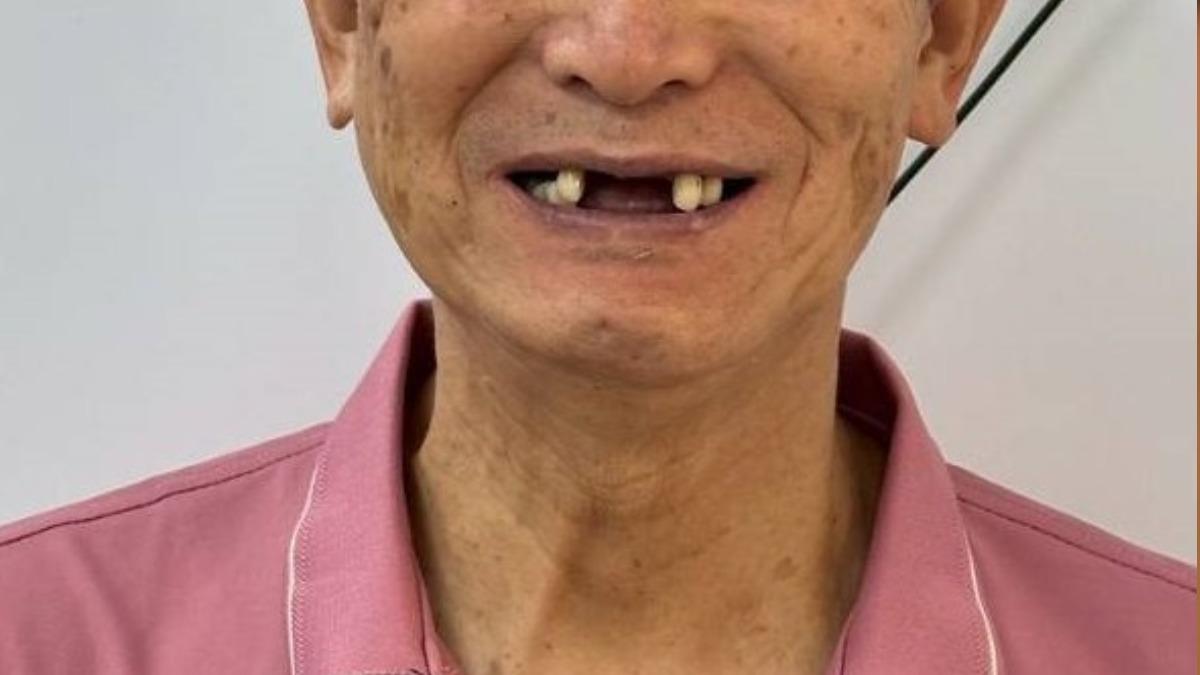 吃飯就痛嘴又臭！台中男不願治能拖就拖　張口見「牙全爛光」