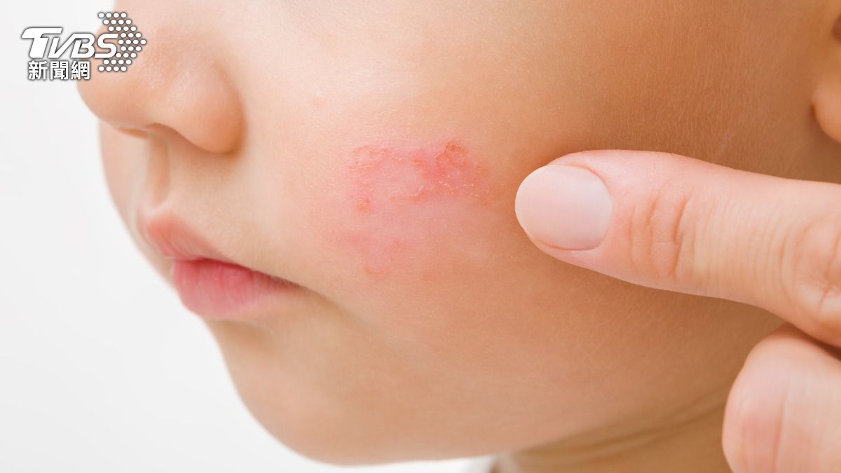 臉紅像被打2巴掌!小女孩確診「蘋果病」 醫示警曝常見症狀