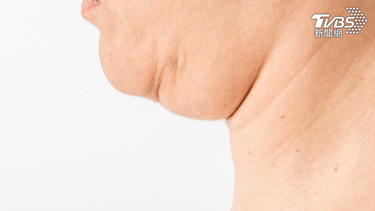 甩肉成功卻成「老態臉」!男星瘦身後臉鬆弛 醫曝2招重拾膠原蛋白