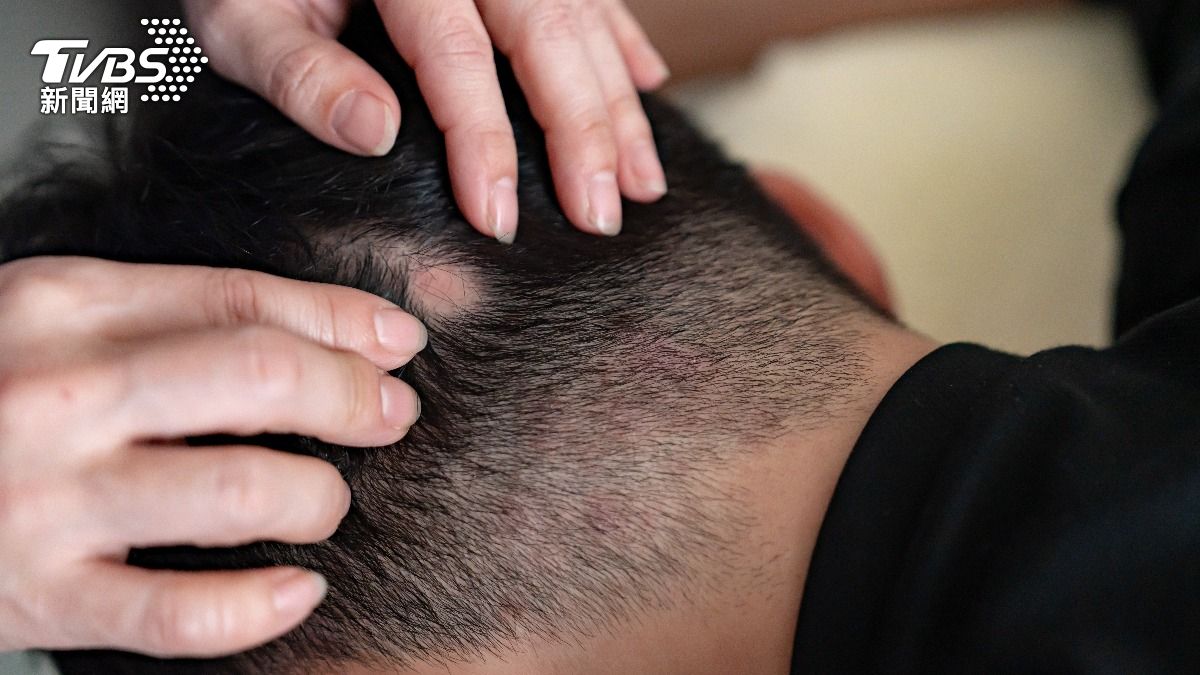 冬天掉髮多怎麼辦?醫師:血液循環差、乾燥是元兇 3重點護頭皮