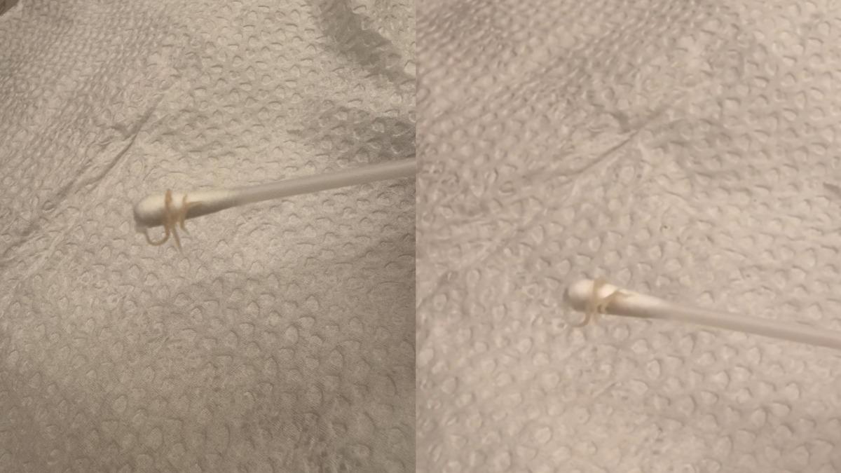 在台灣非絕跡！童肛門掏出白蟯蟲　家中7處易藏卵大小孩都中