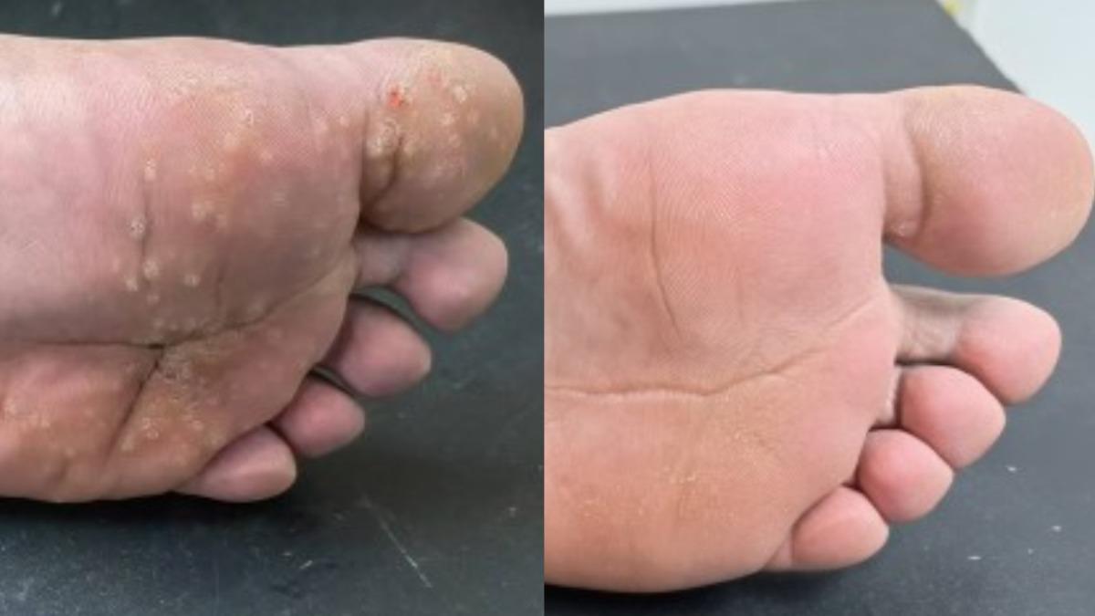 無痛治療!「鹽水泡腳」8週除足底疣 17人成功率98%