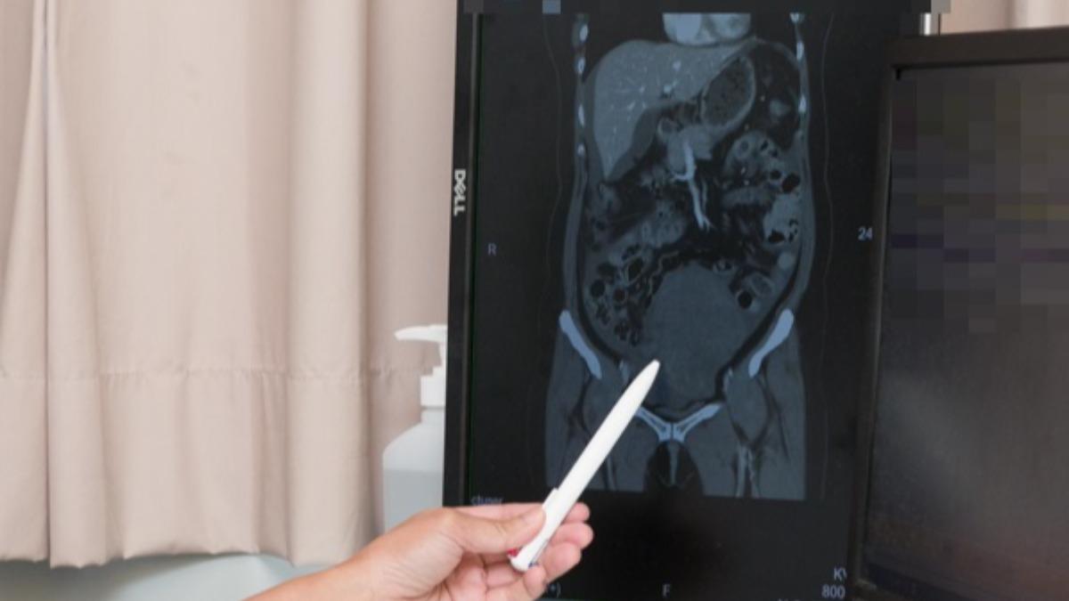 前期無感僅頭暈…台中女一驗腹全是血 醫嘆:成因不明罕見癌